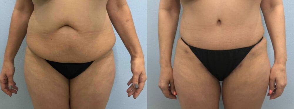 TUMMY TUCK (ABDOMINOPLASTY) PATIENT 43 Front View