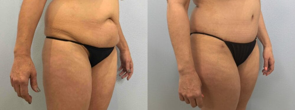 TUMMY TUCK (ABDOMINOPLASTY) PATIENT 43 Left Angle View