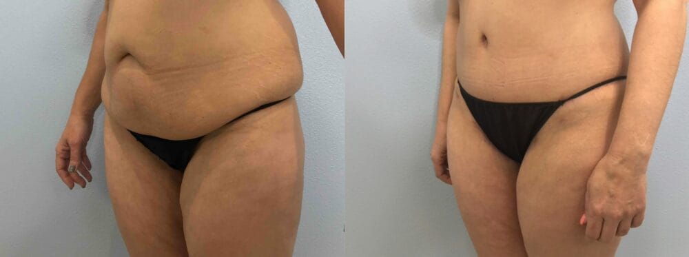 TUMMY TUCK (ABDOMINOPLASTY) PATIENT 43 Right Angle View