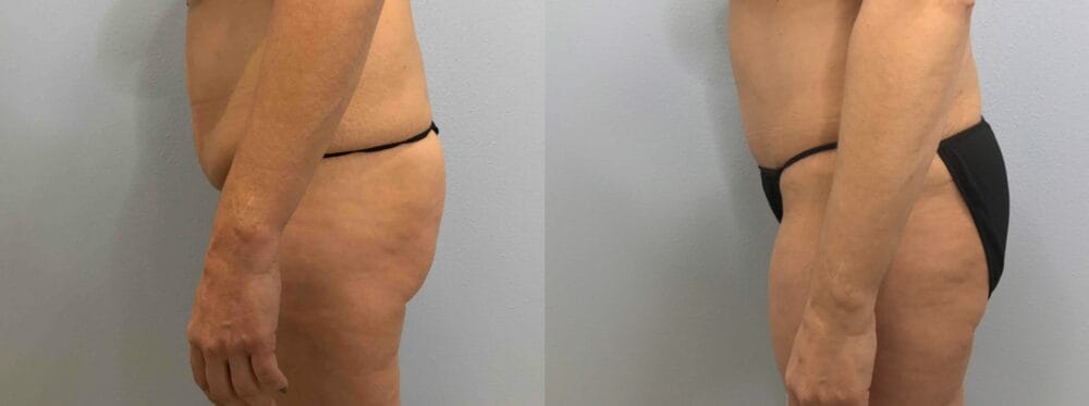 TUMMY TUCK (ABDOMINOPLASTY) PATIENT 43 Right View