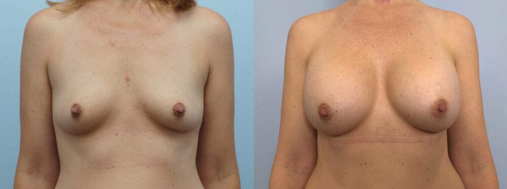 BREAST AUGMENTATION PATIENT 78 front view