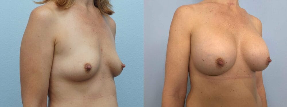 BREAST AUGMENTATION PATIENT 78 left angle view