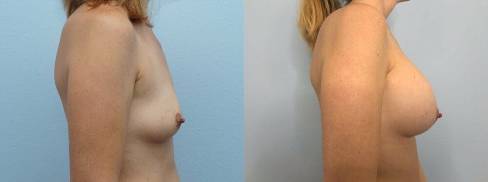 BREAST AUGMENTATION PATIENT 78 left view