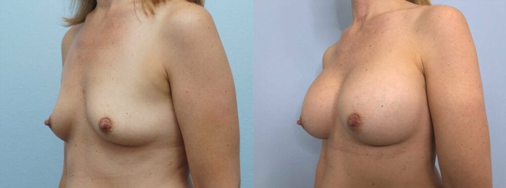 BREAST AUGMENTATION PATIENT 78 right angle view