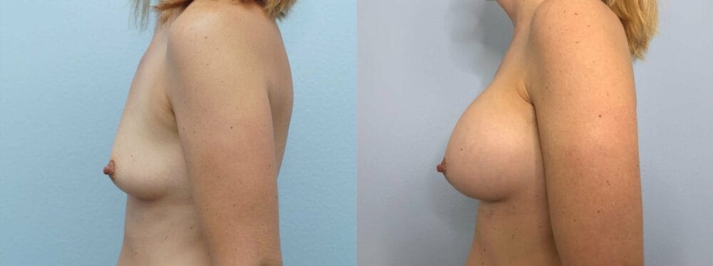 BREAST AUGMENTATION PATIENT 78 right view