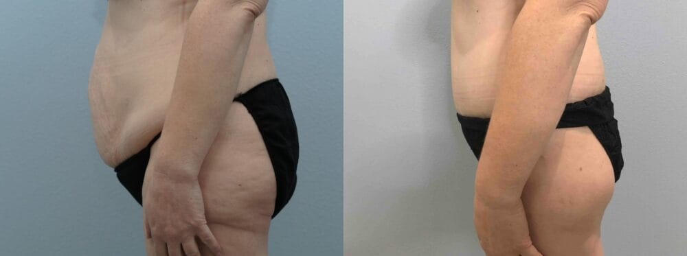 Body Lift (Circumferential ABDOMINOPLASTY) PATIENT 44 Right View