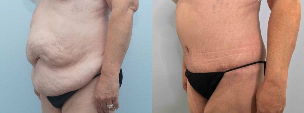 tummy tuck patient 51 right angle view