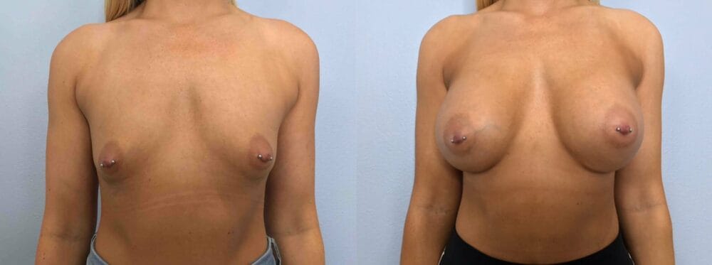 breast augmemtation patient 76 front view