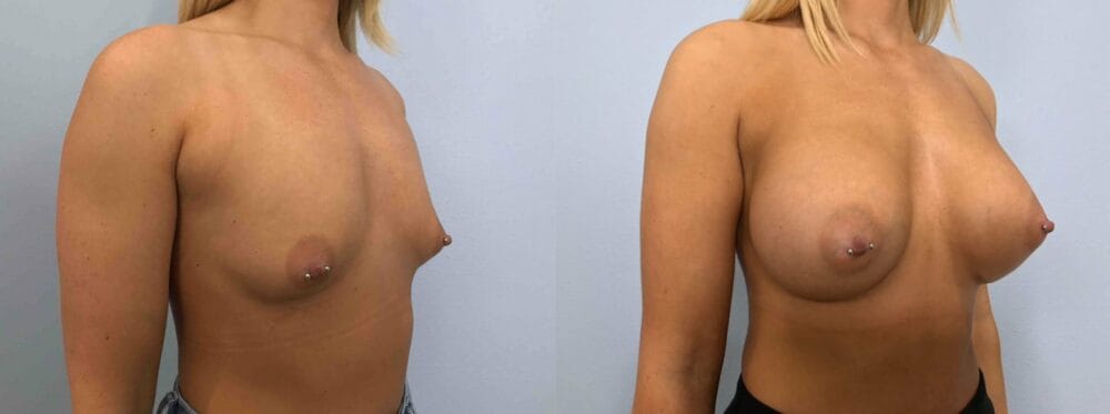 breast augmemtation patient 76 left angle view
