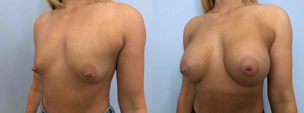 breast augmemtation patient 76 right angle view