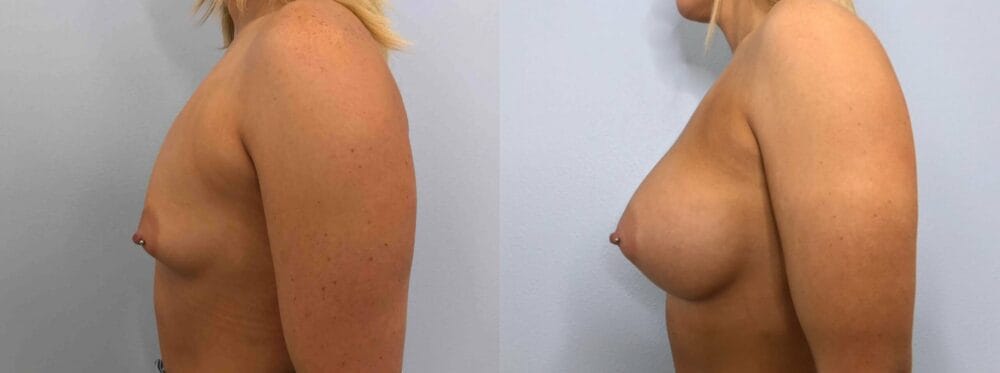 breast augmemtation patient 76 right view