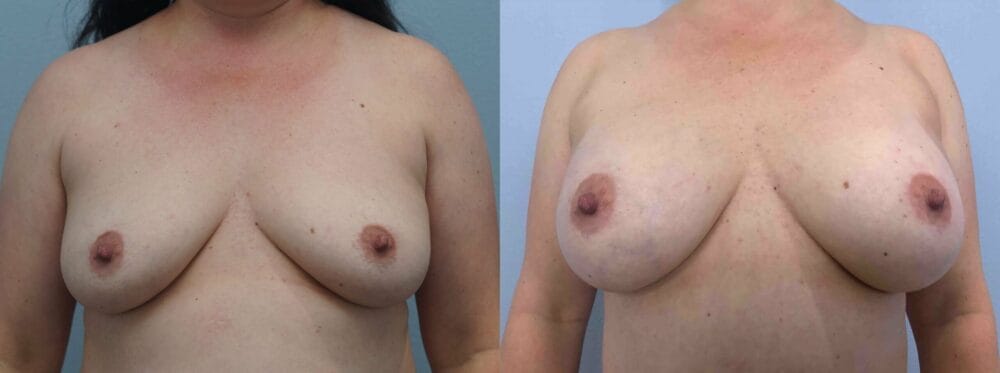 breast augmentation patient 75 front view