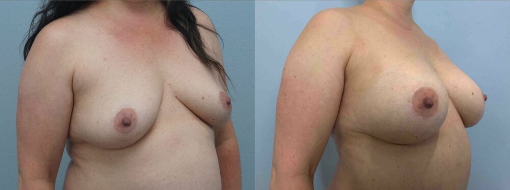 breast augmentation patient 75 left angle view