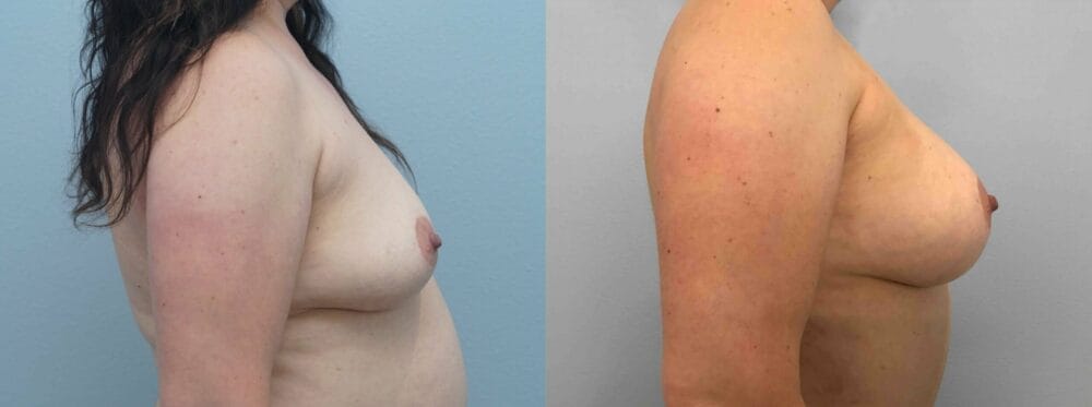 breast augmentation patient 75 left view