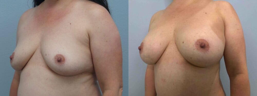 breast augmentation patient 75 right angle view