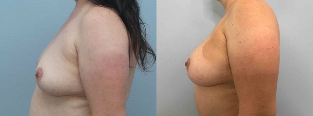 breast augmentation patient 75 right view