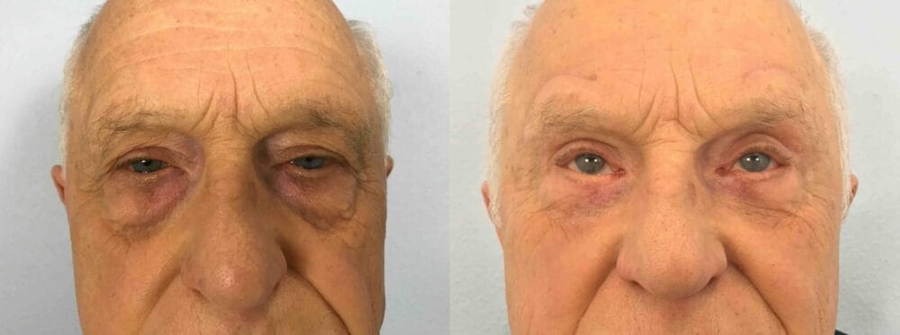 EYELID SURGERY (BLEPHAROPLASTY) PATIENT 18 front view