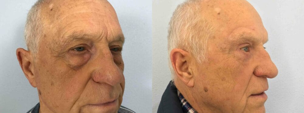 EYELID SURGERY (BLEPHAROPLASTY) PATIENT 18 left angle view