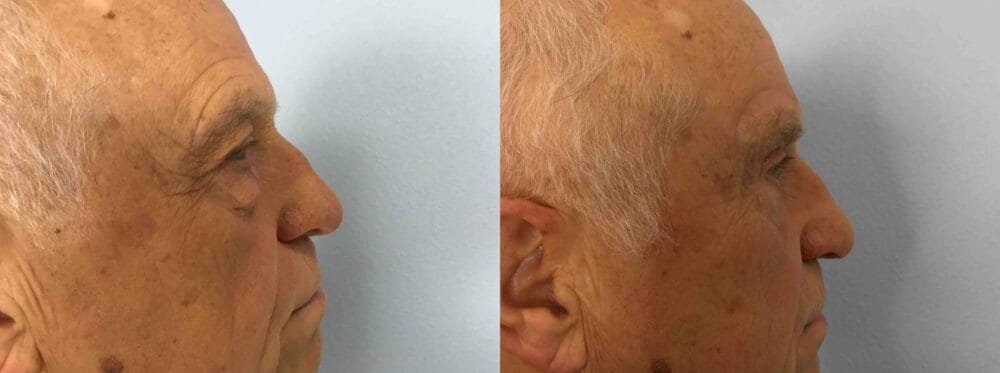 EYELID SURGERY (BLEPHAROPLASTY) PATIENT 18 left view