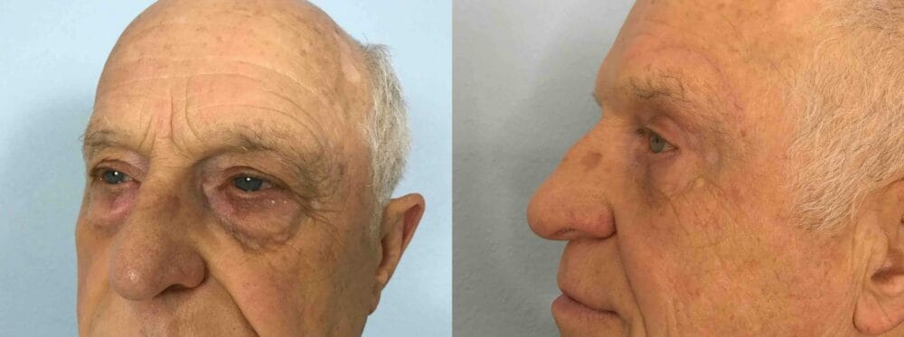 EYELID SURGERY (BLEPHAROPLASTY) PATIENT 18 right angle view