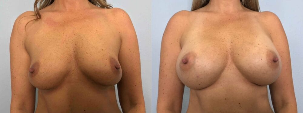 breast augmentation patient 77 front view