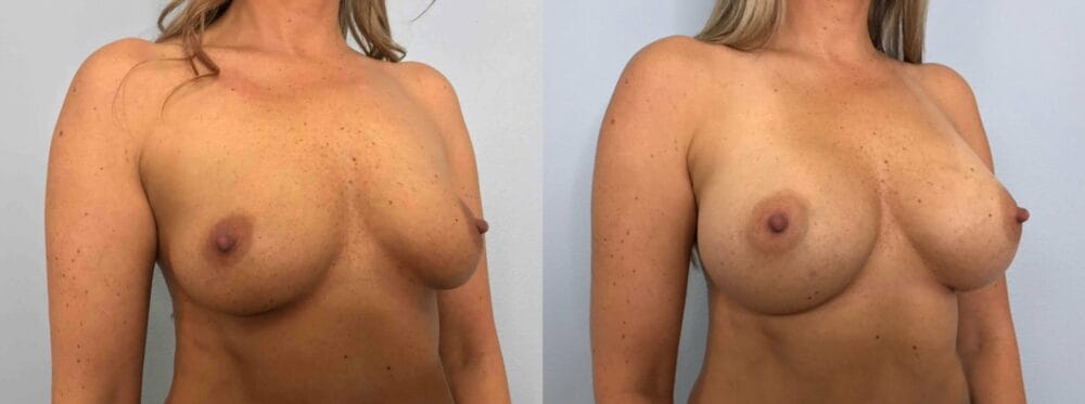 breast augmentation patient 77 left angle view