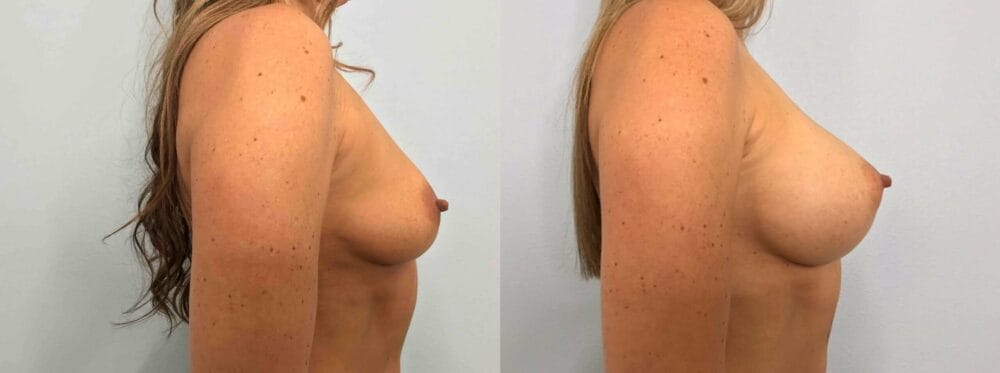 breast augmentation patient 77 left view