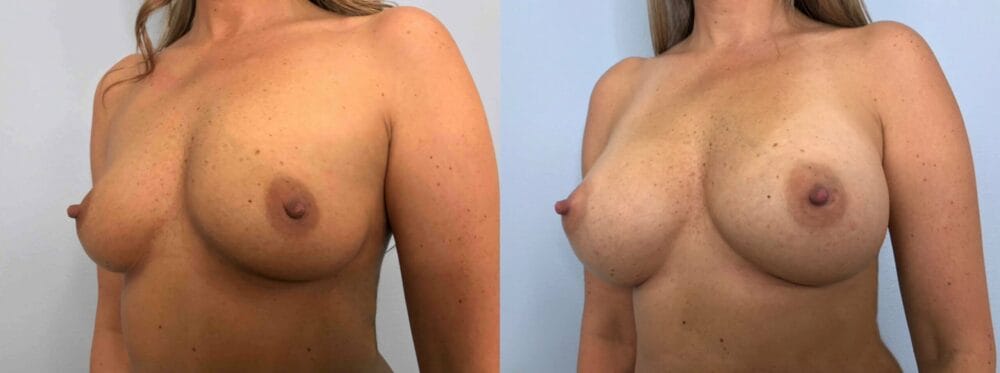 breast augmentation patient 77 right angle view