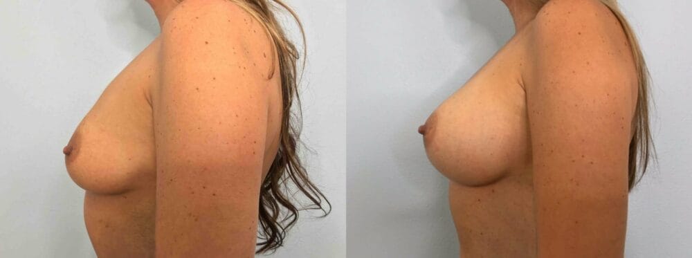 breast augmentation patient 77 right view