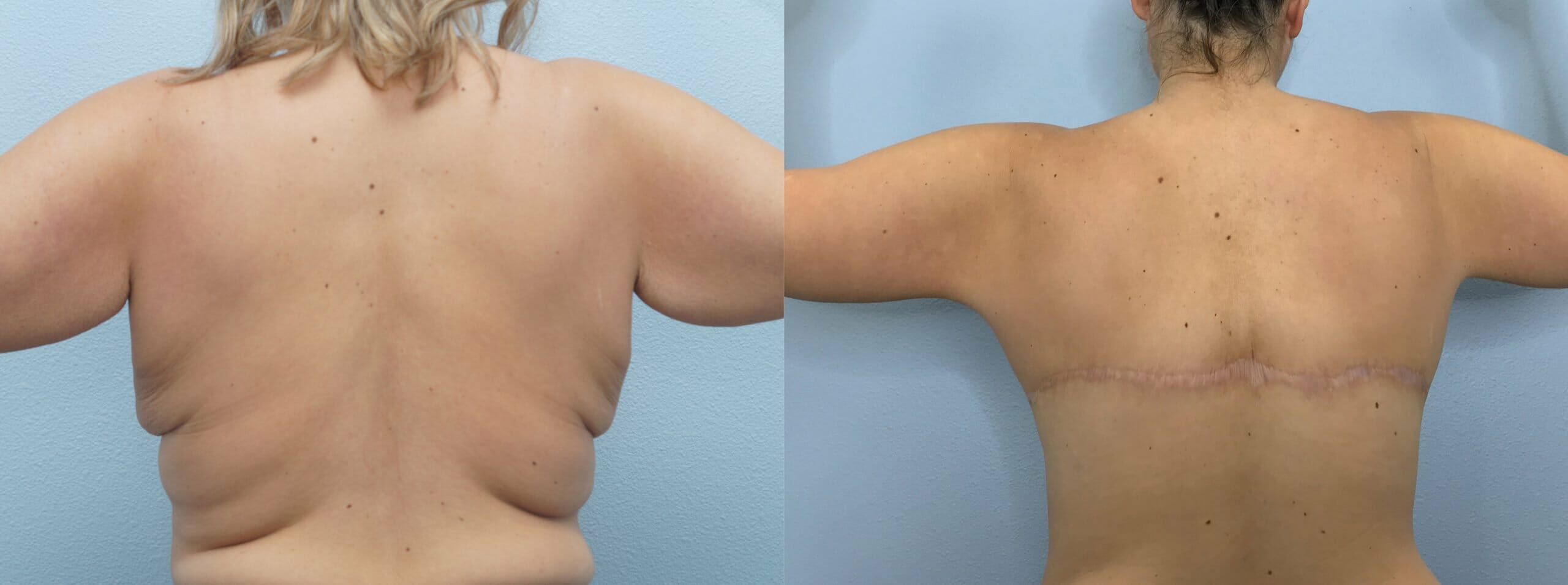 This is a Bra-Line Back Lift. It's an incredible surgery to