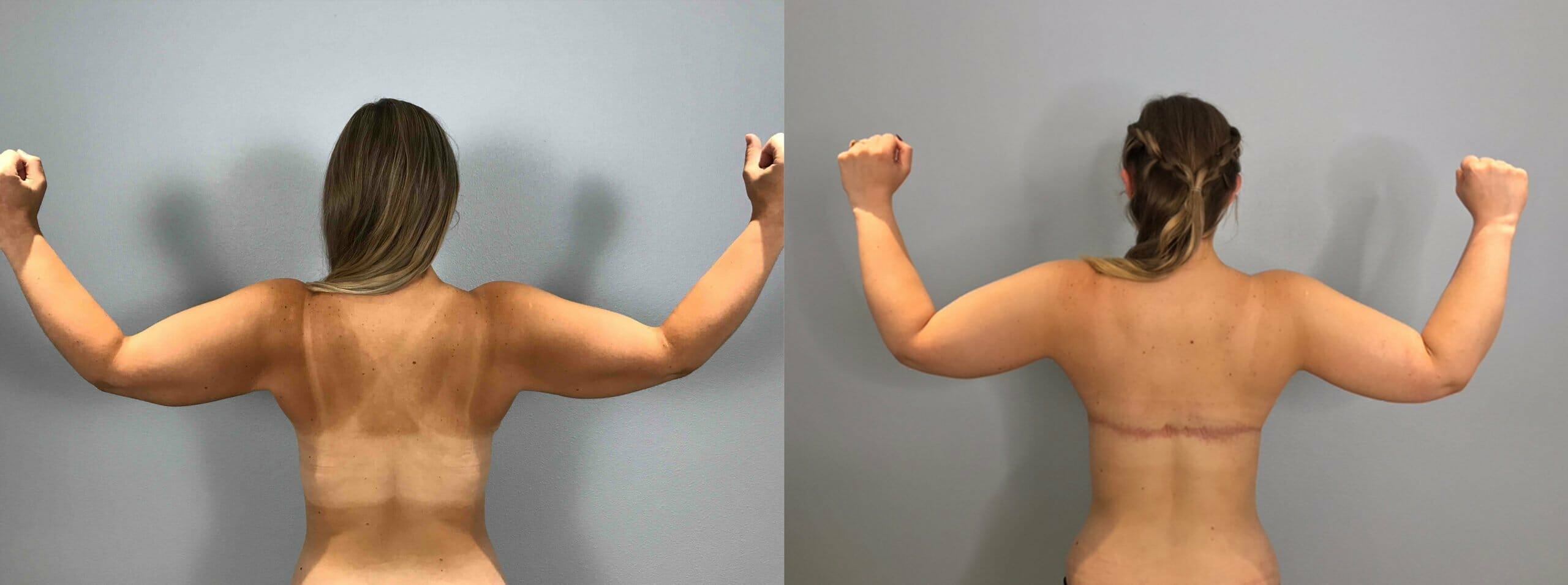 Bra Line Back Lift Before & After Photos Patient 1154
