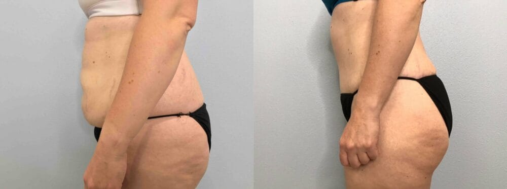 tummy tuck patient 52 right view