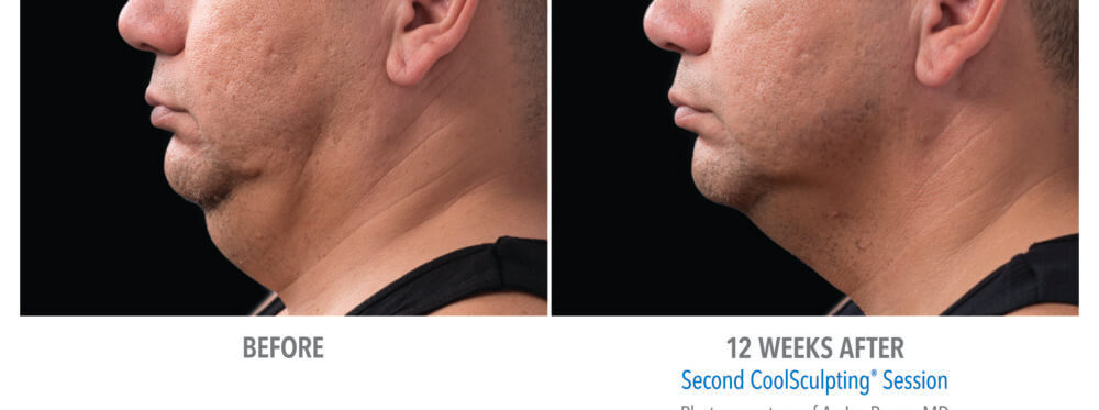 coolsculpting patient 14 under chin view