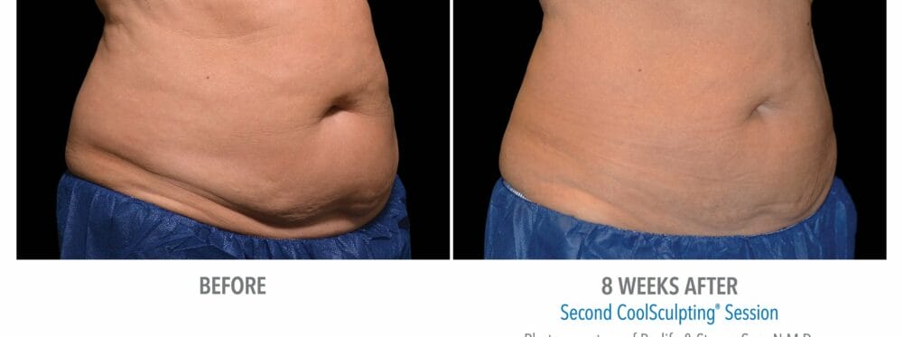 coolsculpting patient 19 side view