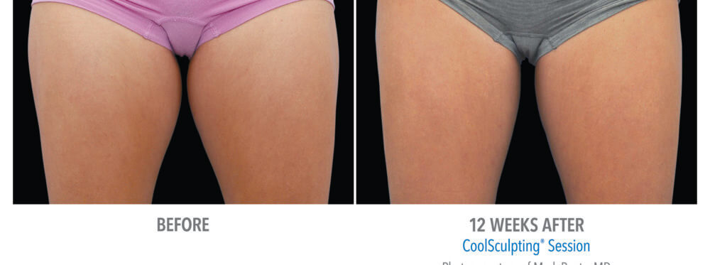 coolsculpting patient 11 thighs view