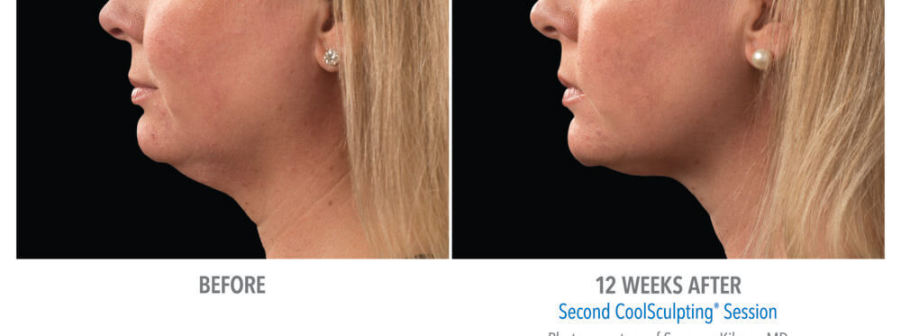 coolsculpting patient 18 under chin view