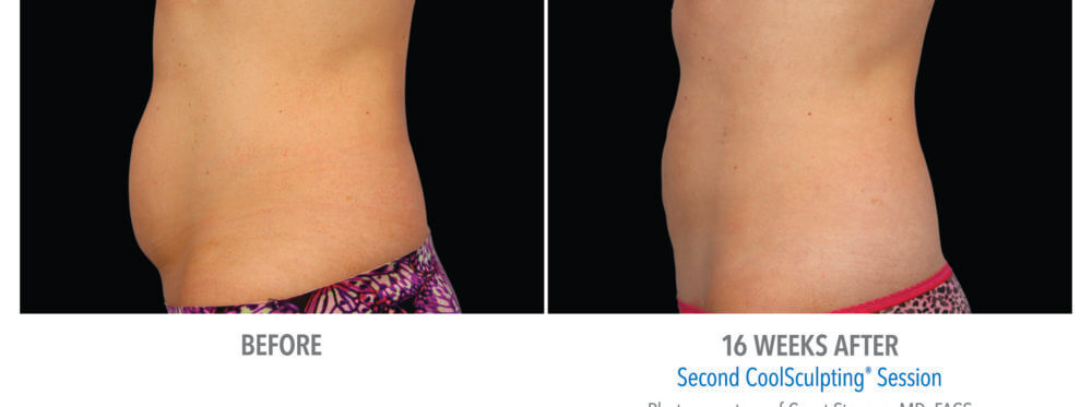 coolsculpting patient 17 side view