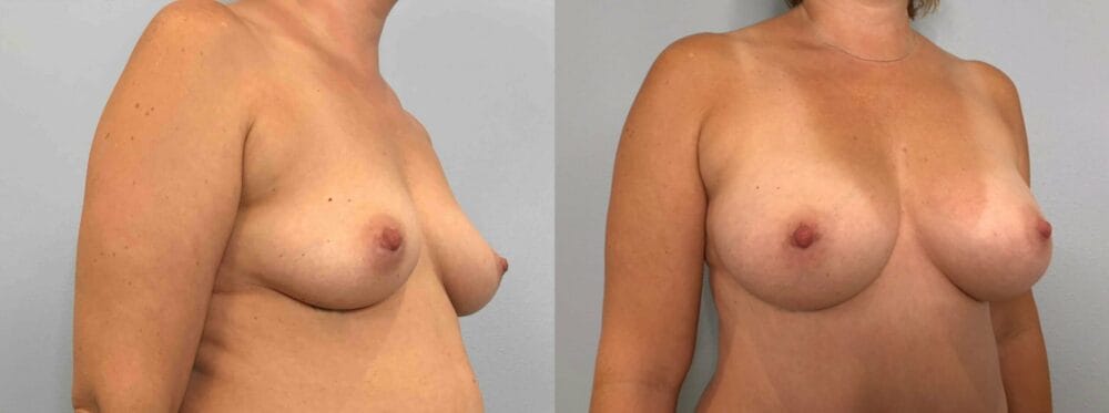 BREAST AUGMENTATION PATIENT 81 left angle view