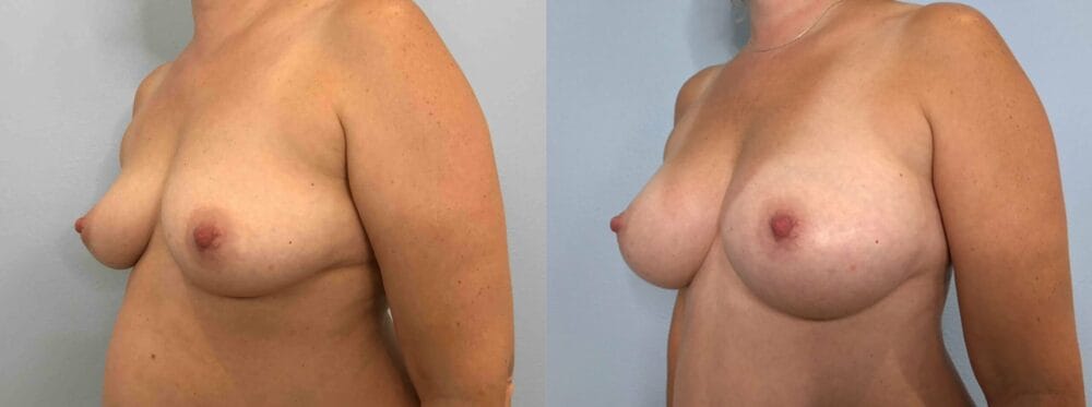 BREAST AUGMENTATION PATIENT 81 right angle view