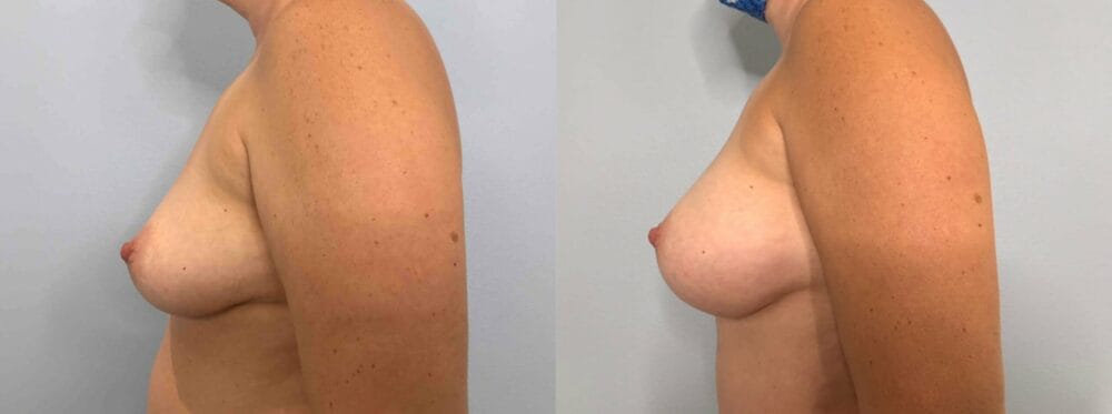 BREAST AUGMENTATION PATIENT 81 right view
