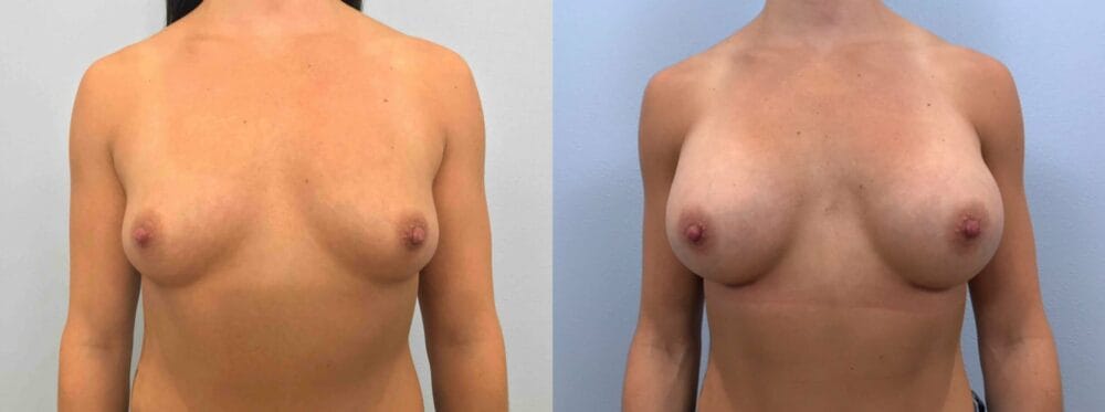 BREAST AUGMENTATION PATIENT 79 front view