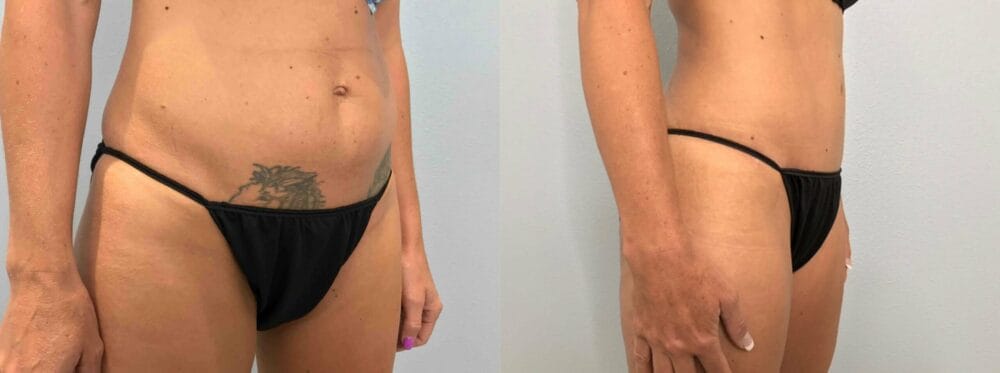 Tummy Tuck Patient 68 left angle view