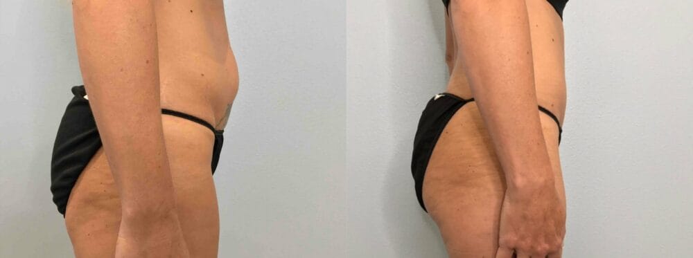 Tummy Tuck Patient 68 left view