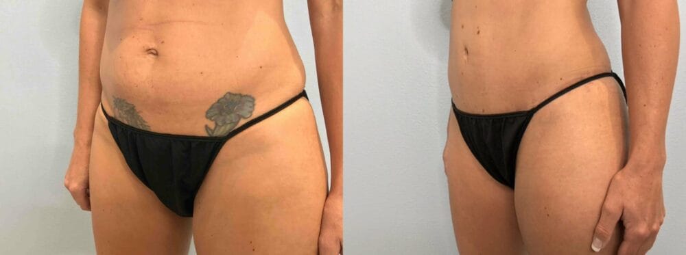 Tummy Tuck Patient 68 right angle view