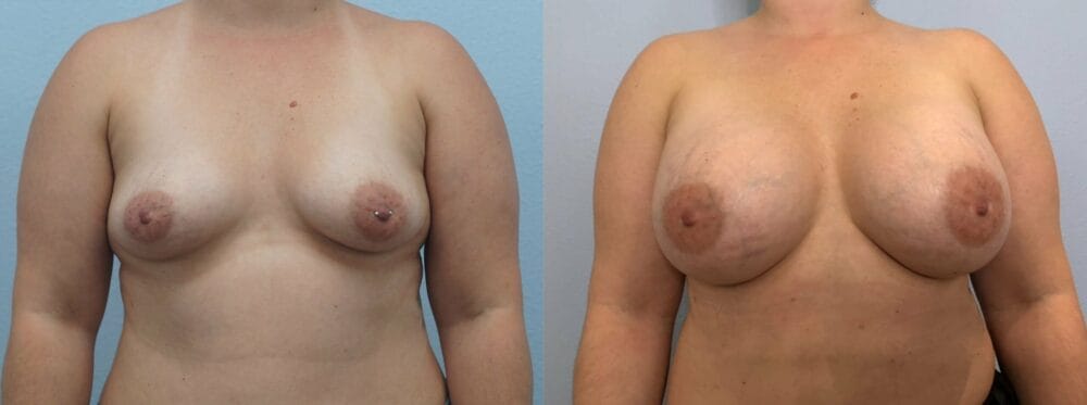 breast augmentation patient 83 front view