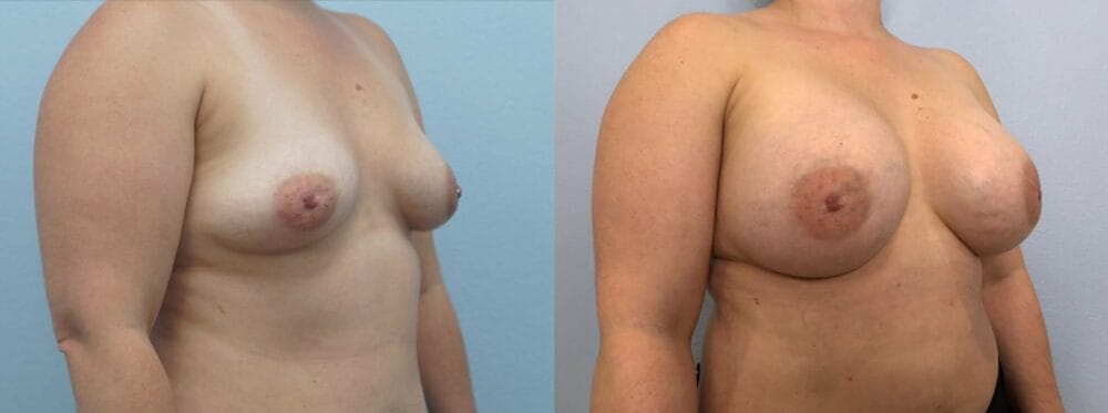 breast augmentation patient 83 left angle view