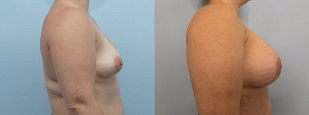 breast augmentation patient 83 left view