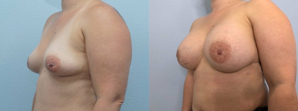 breast augmentation patient 83 right angle view