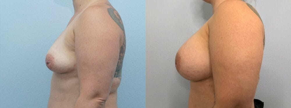 breast augmentation patient 83 right view