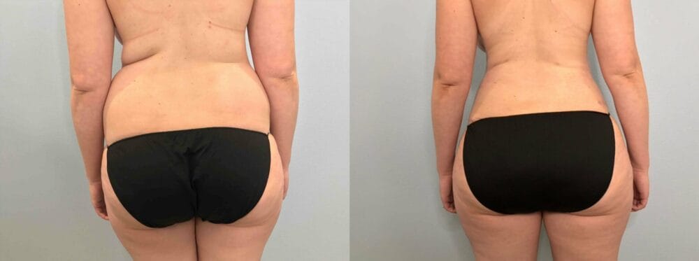 Tummy Tuck Patient 66 back view